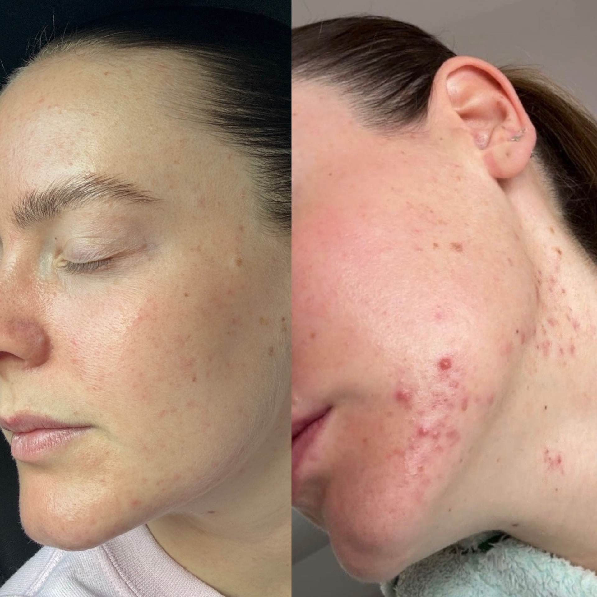 Client skin transformation 3 — before and after the Clear Skin Protocol