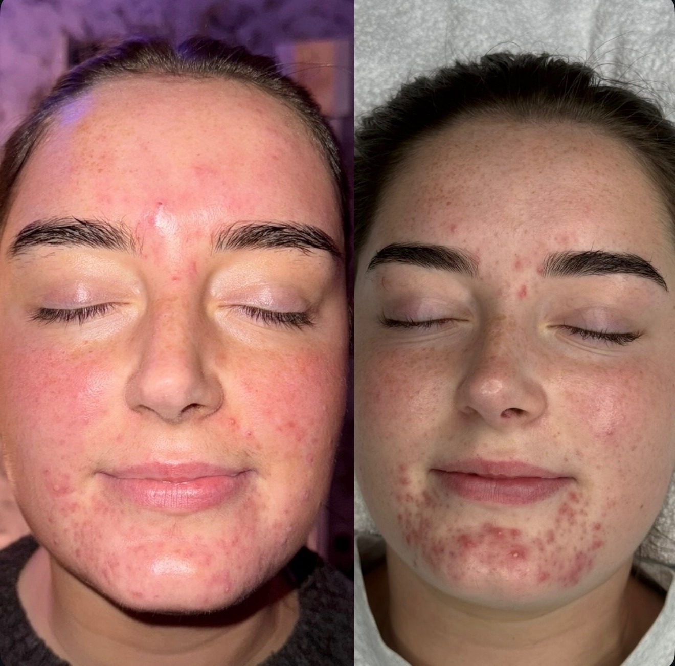 Client skin transformation — before and after the Clear Skin Protocol (4)