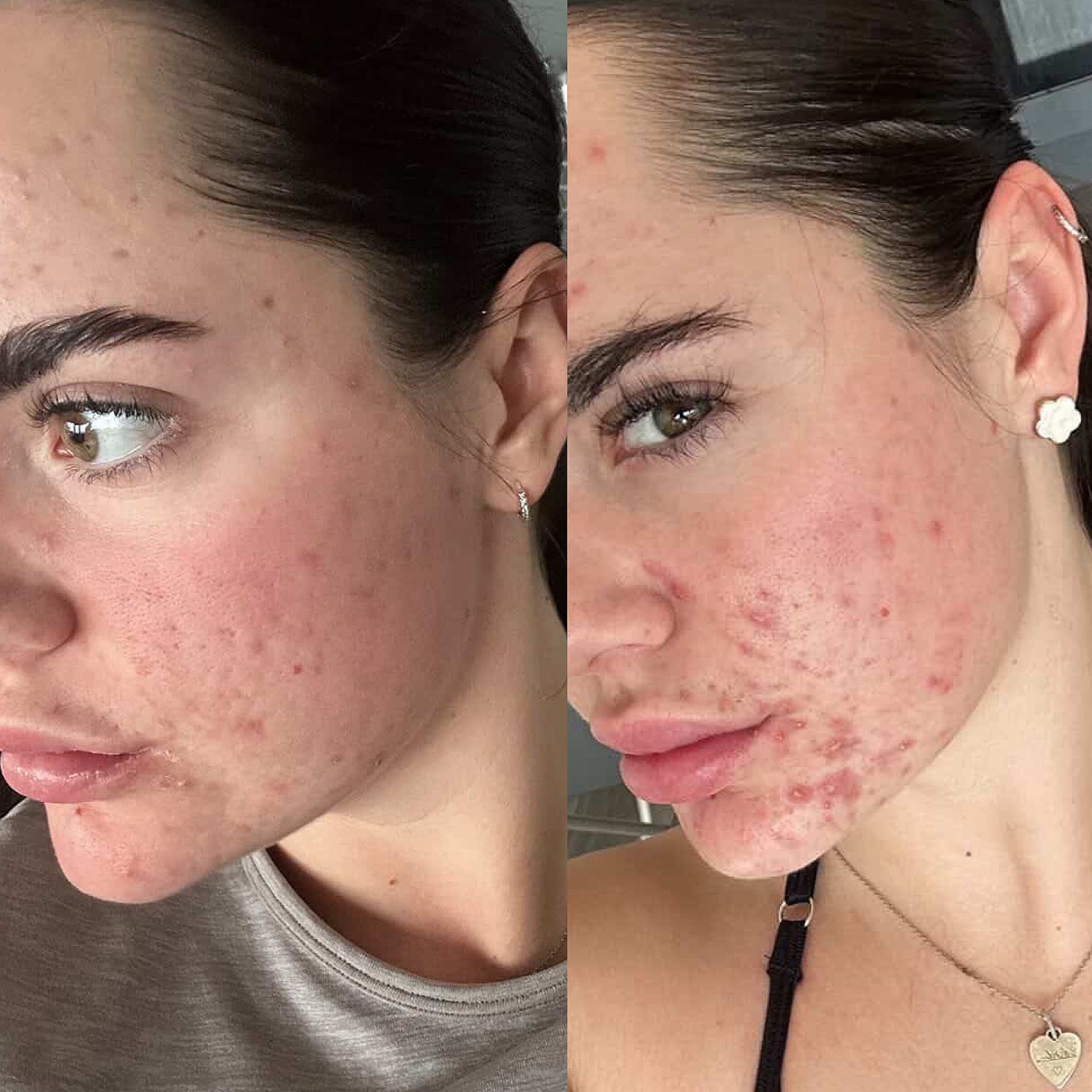 Client skin transformation 2 — before and after the Clear Skin Protocol