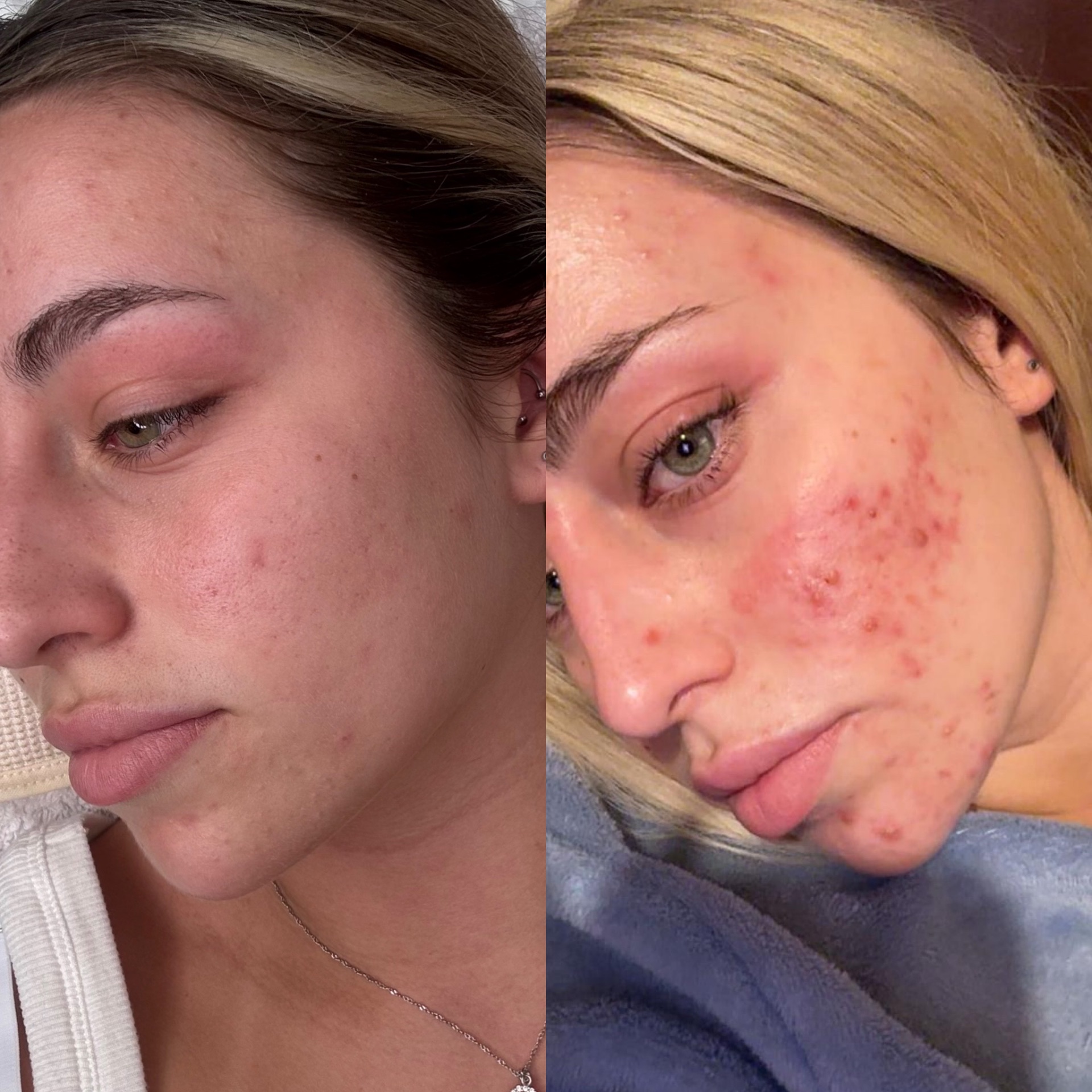 Client skin transformation 4 — before and after the Clear Skin Protocol
