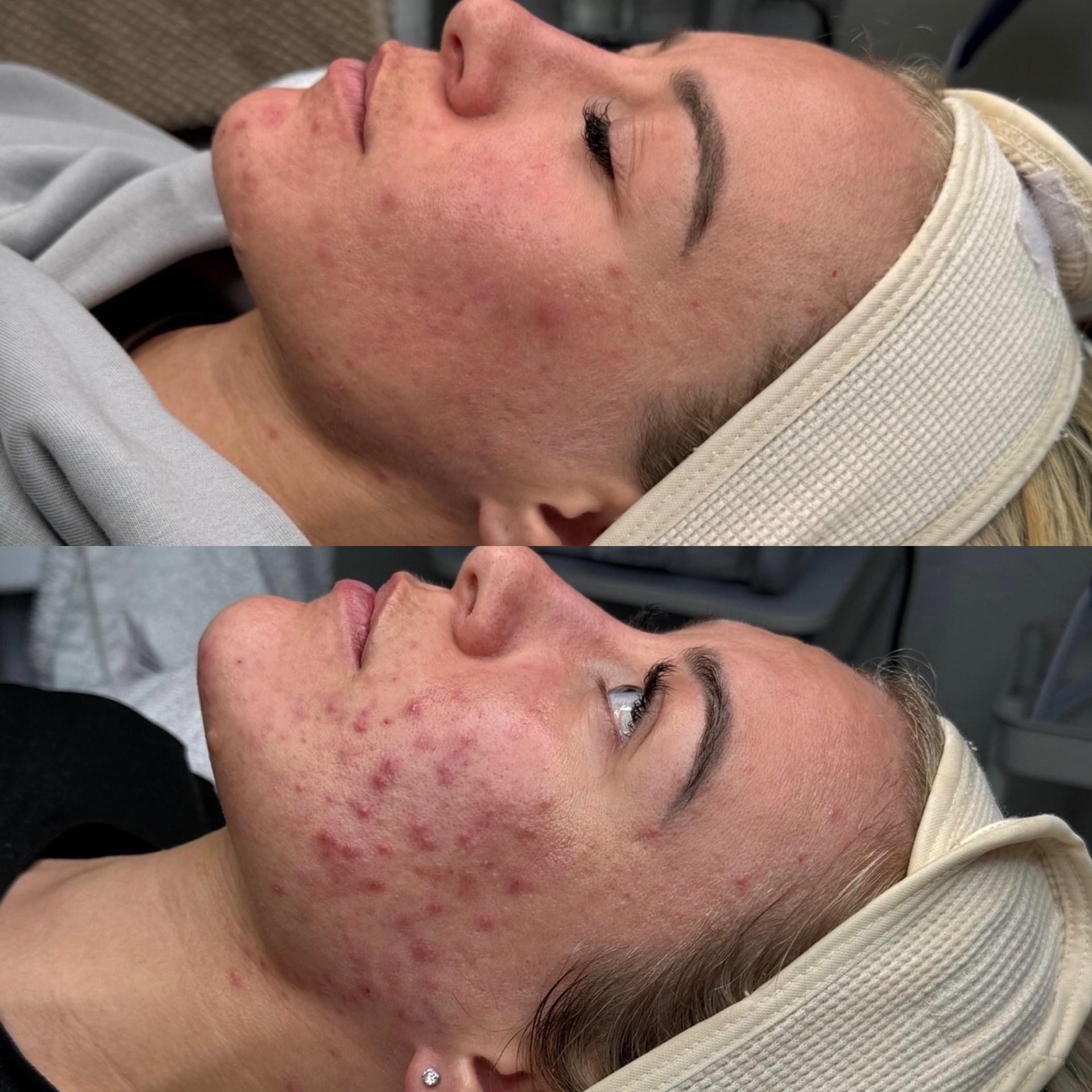 Client skin transformation 5 — before and after the Clear Skin Protocol