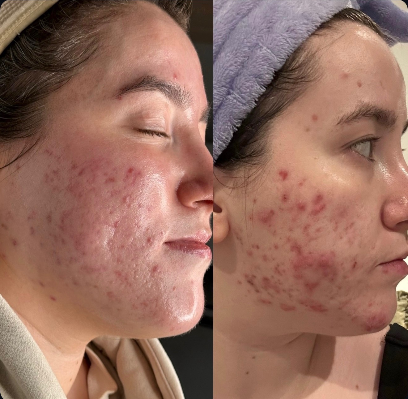 Client skin transformation — before and after the Clear Skin Protocol (2)