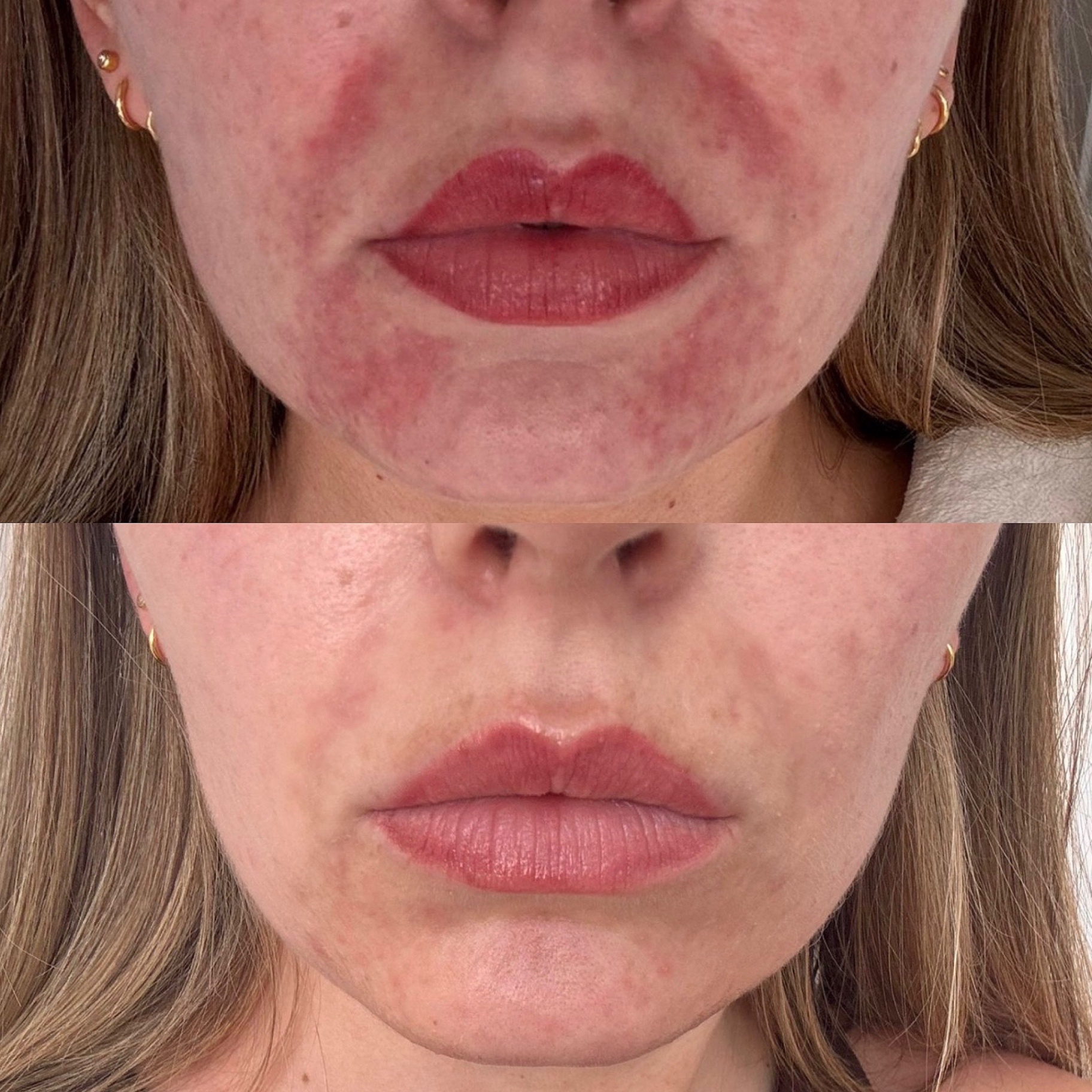 Client skin transformation — before and after the Clear Skin Protocol (1)