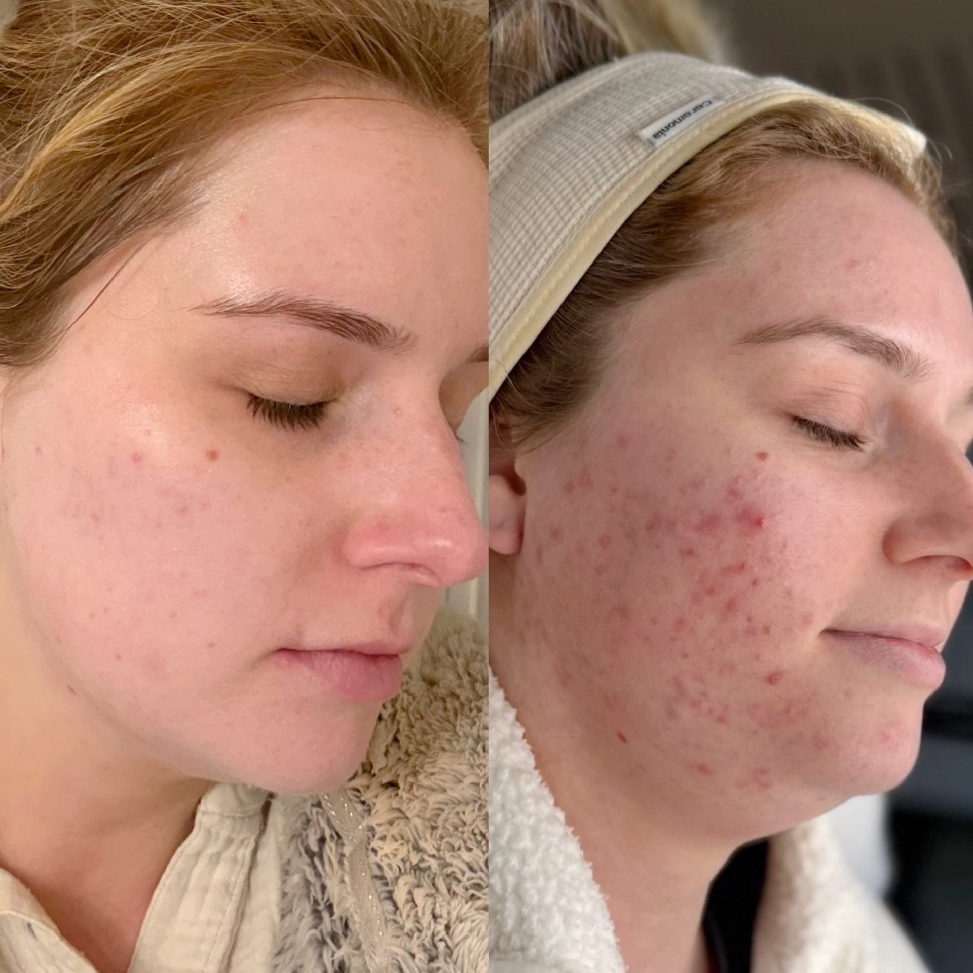 Client skin transformation 1 — before and after the Clear Skin Protocol