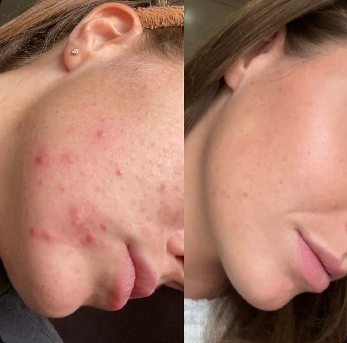 Client skin transformation — before and after the Clear Skin Protocol (3)