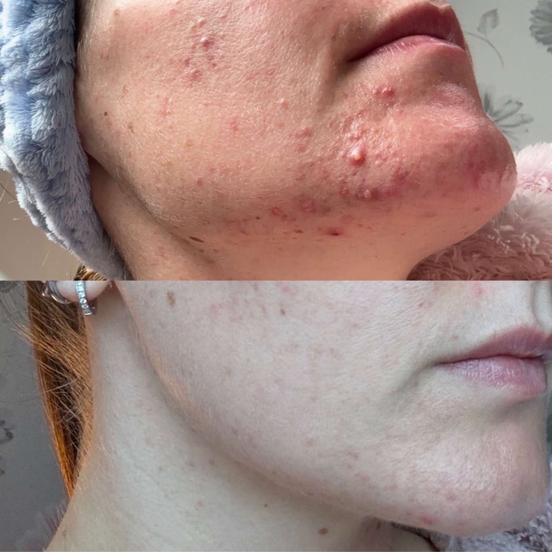 Client skin transformation 6 — before and after the Clear Skin Protocol